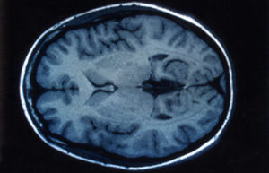 Imagine RMN creier adolescent